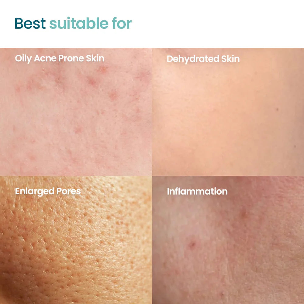 WishCare Acne Essential Combo